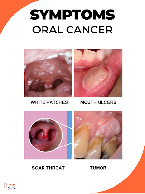 Oral Cancer - Early Detection & Home Treatments